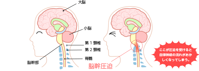 脳幹圧迫